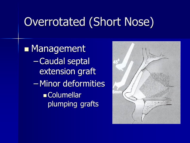 Overrotated (Short Nose) Management Caudal septal extension graft Minor deformities  Columellar plumping grafts
